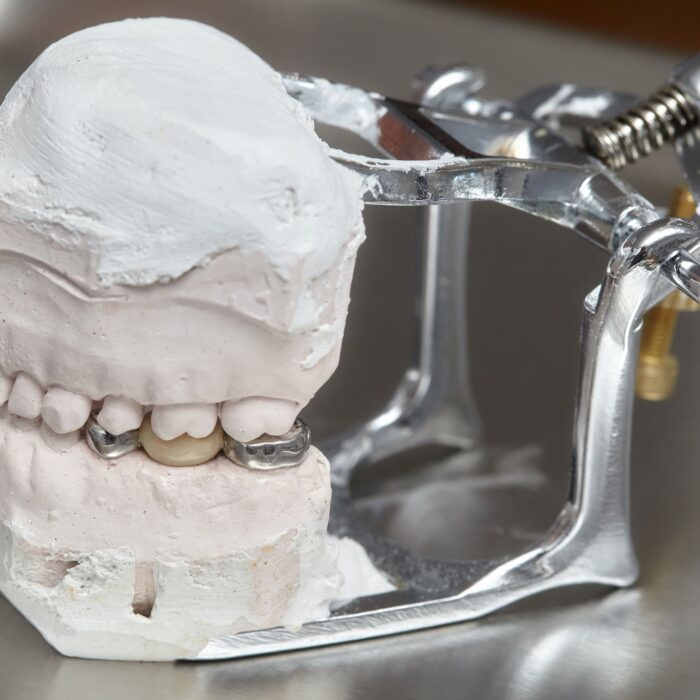 Protesi Dentali su Impianti a Iseo