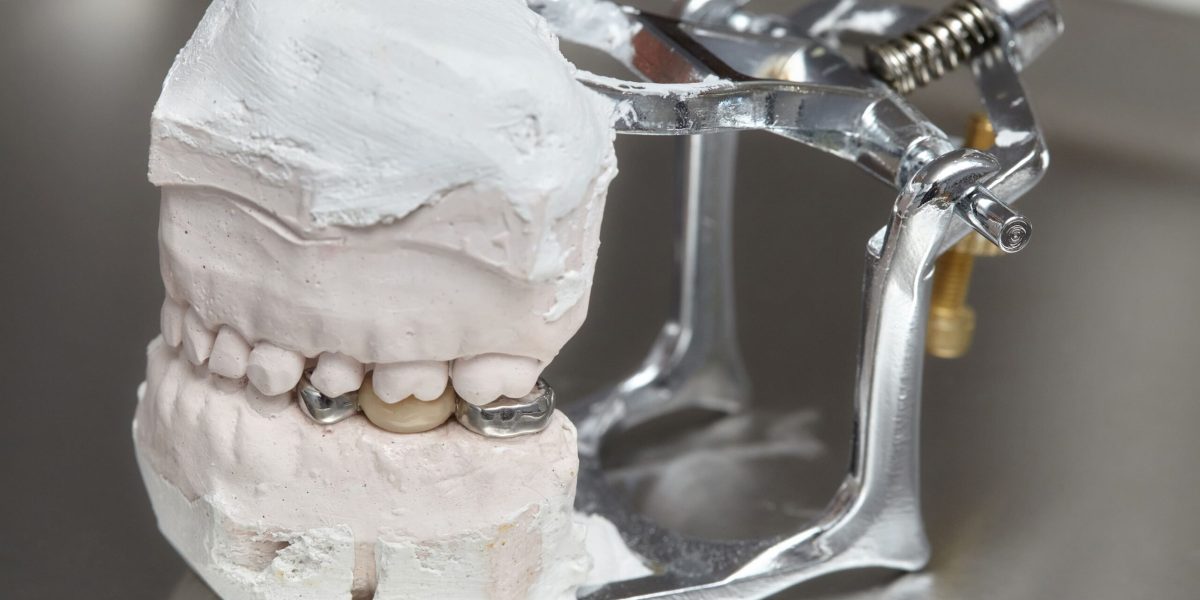 Protesi Dentali su Impianti a Iseo